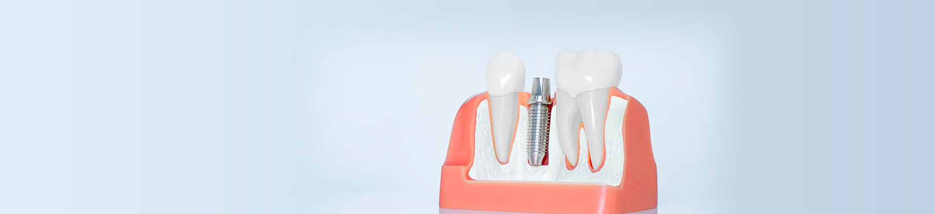 インプラント