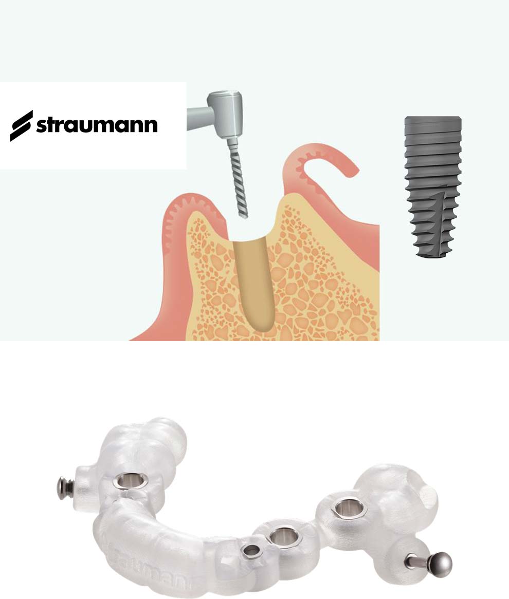 インプラント体の埋入