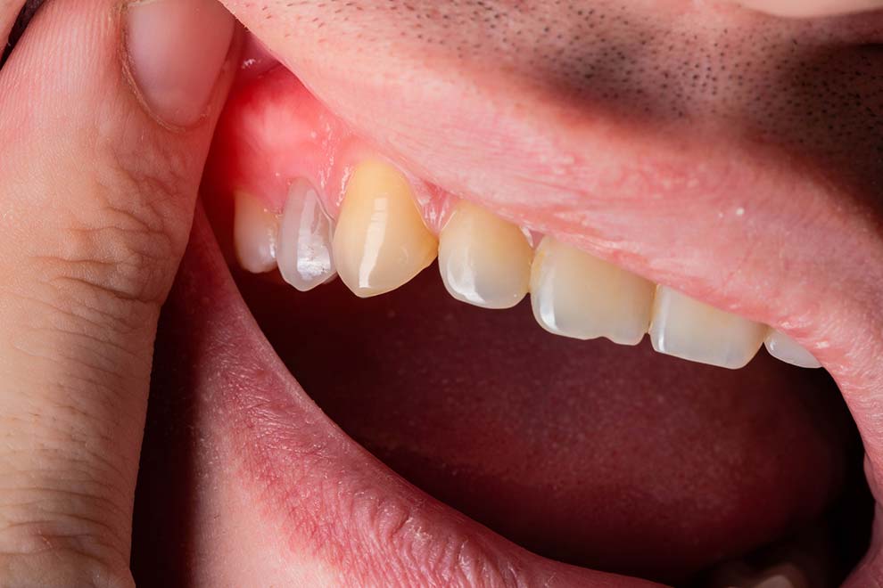 インプラント周囲炎